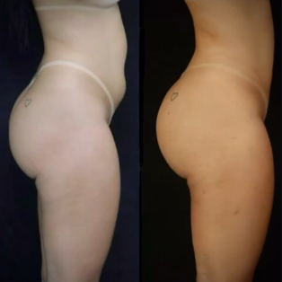 lipoenxertia-antes-depois